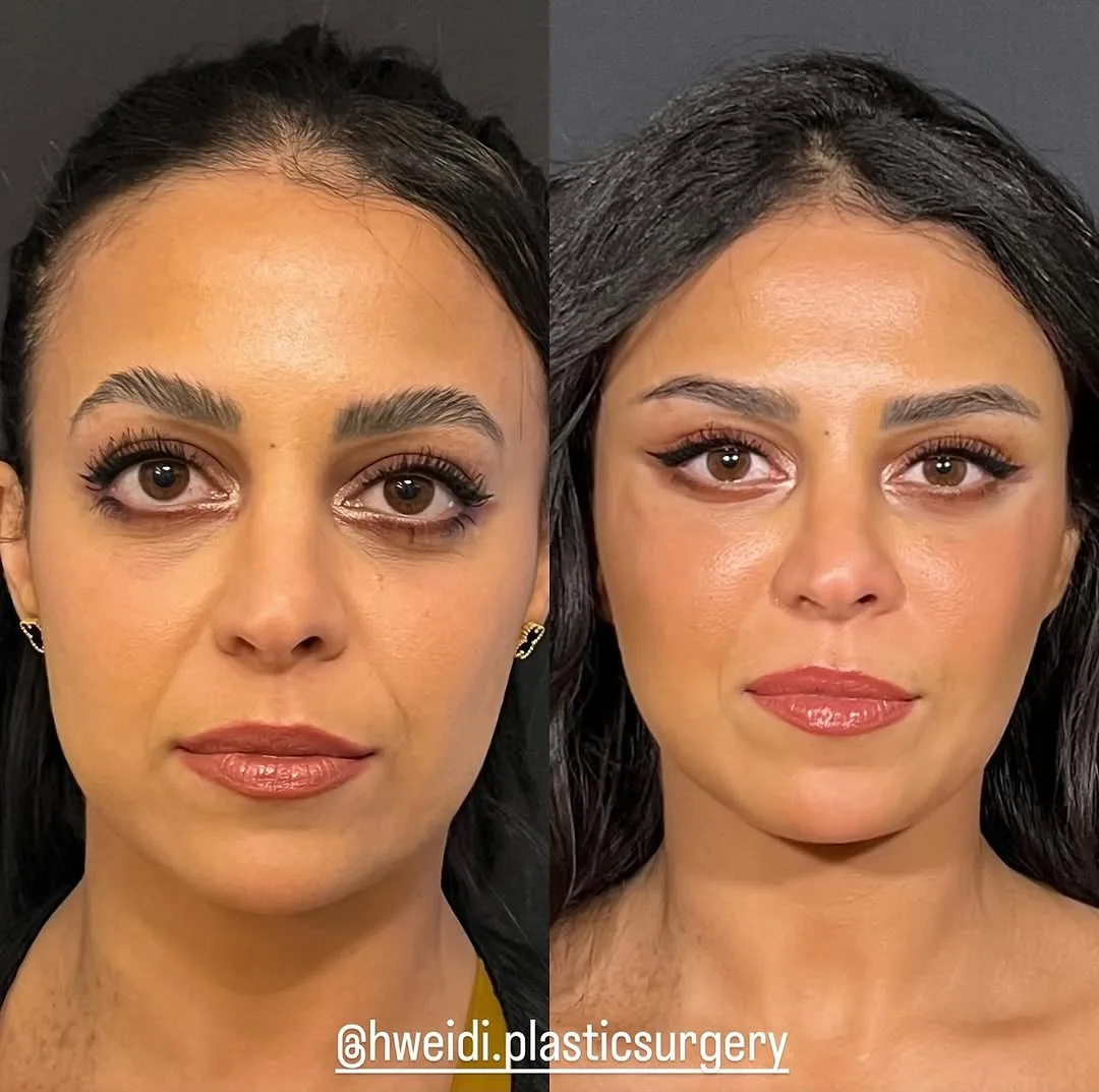Before and after deep plane facelift — 45-year-old woman, frontal view, 6mo post-op by Dr. Laith Hweidi