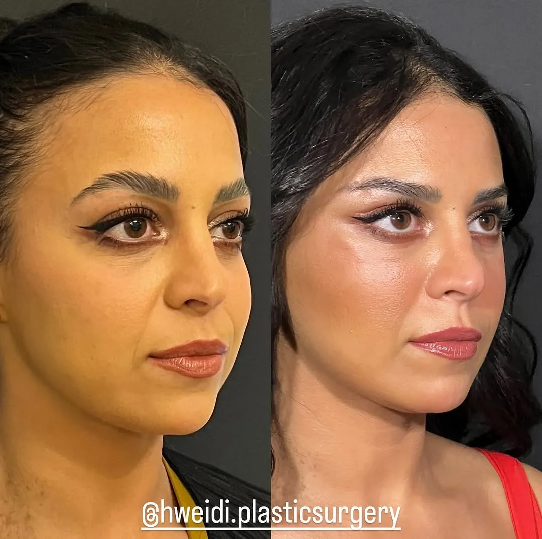 Before and after deep plane facelift — 38-year-old woman, oblique right view, 6mo post-op by Dr. Laith Hweidi