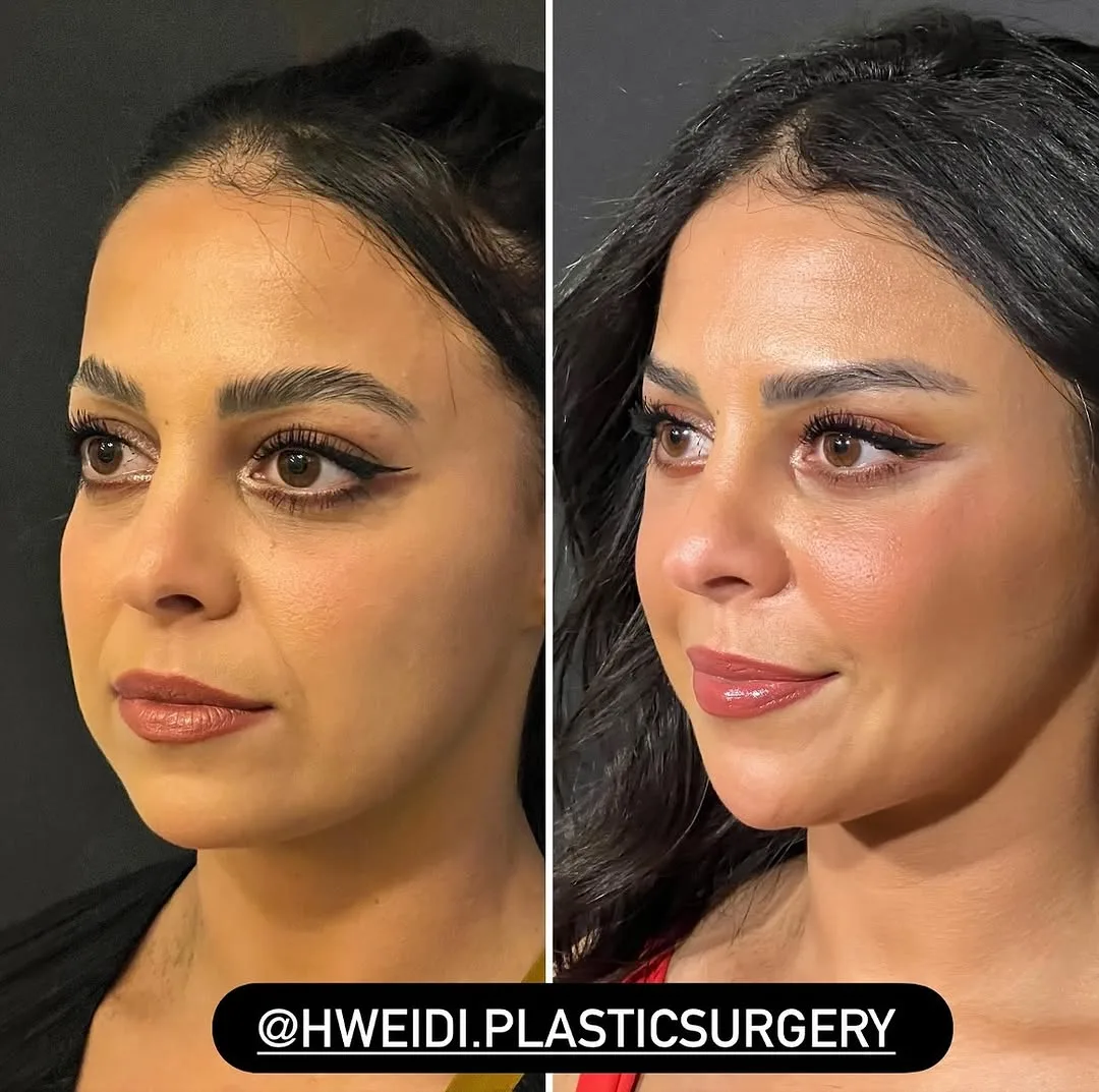 Before and after deep plane facelift — 35-year-old woman, oblique right view, 6mo post-op by Dr. Laith Hweidi