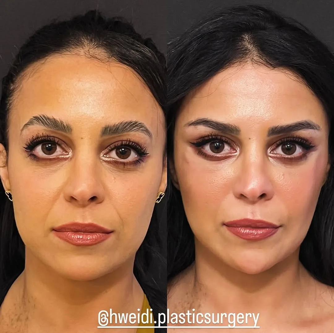 Before and after deep plane facelift — 42-year-old woman, frontal view, 7mo post-op by Dr. Laith Hweidi