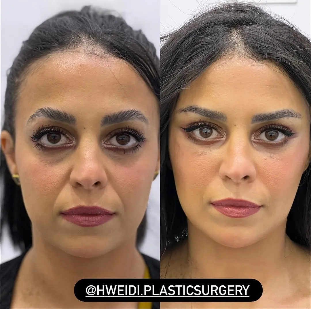 Before and after deep plane facelift — 45-year-old woman, frontal view, 7mo post-op by Dr. Laith Hweidi