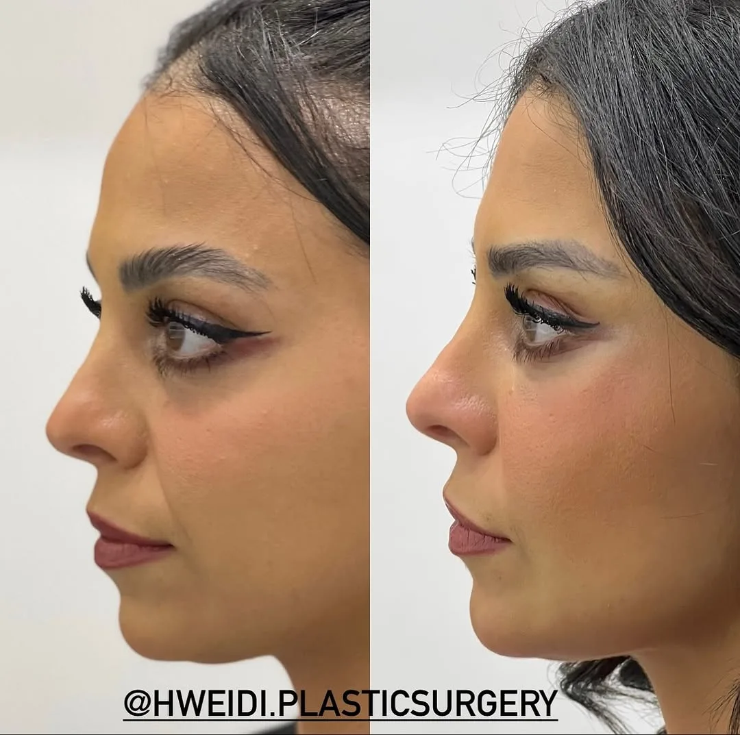 Before and after deep plane facelift — 28-year-old woman, left profile view, 6mo post-op by Dr. Laith Hweidi