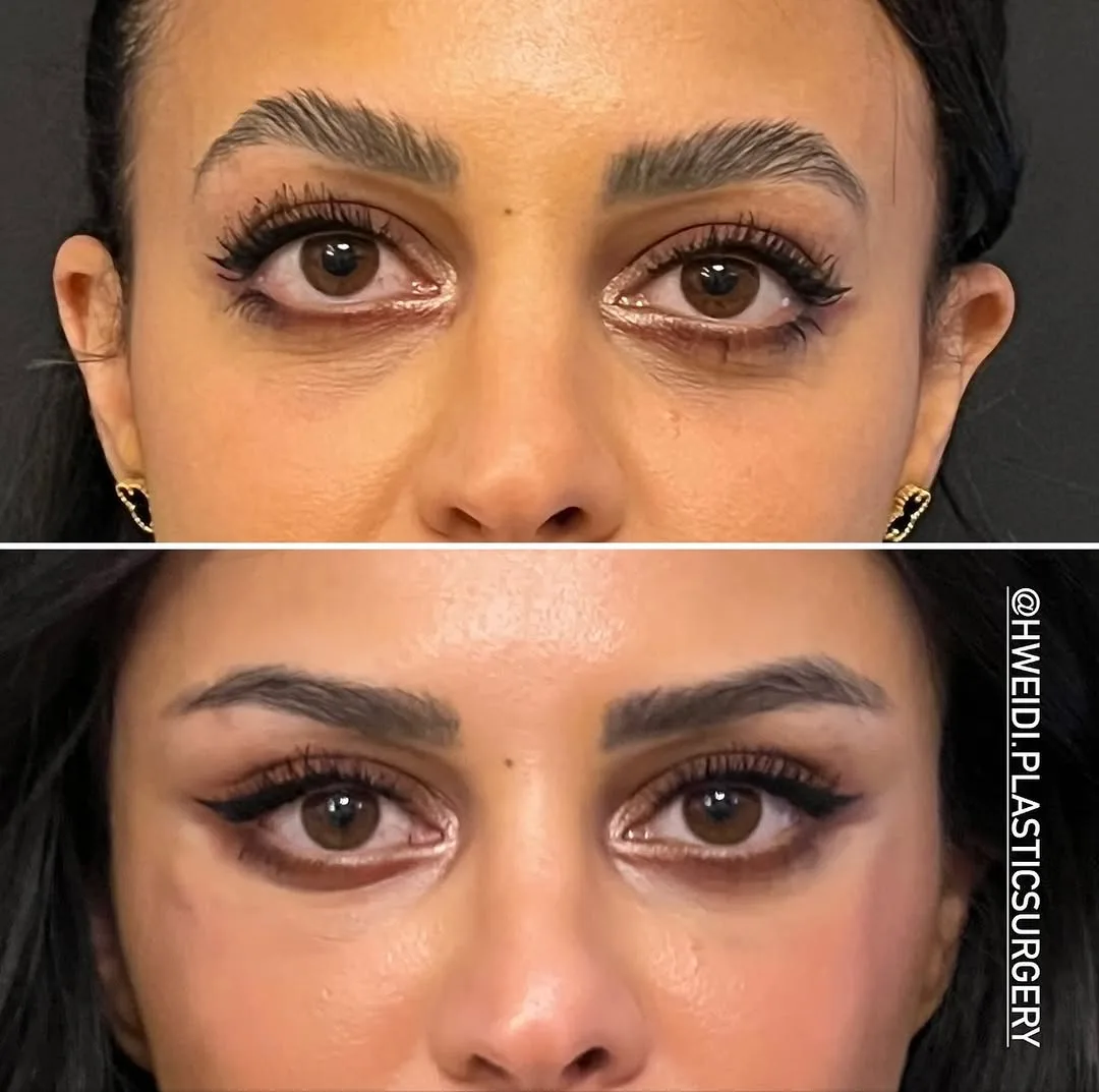 Before and after deep plane facelift — 32-year-old woman, frontal view, 6mo post-op by Dr. Laith Hweidi