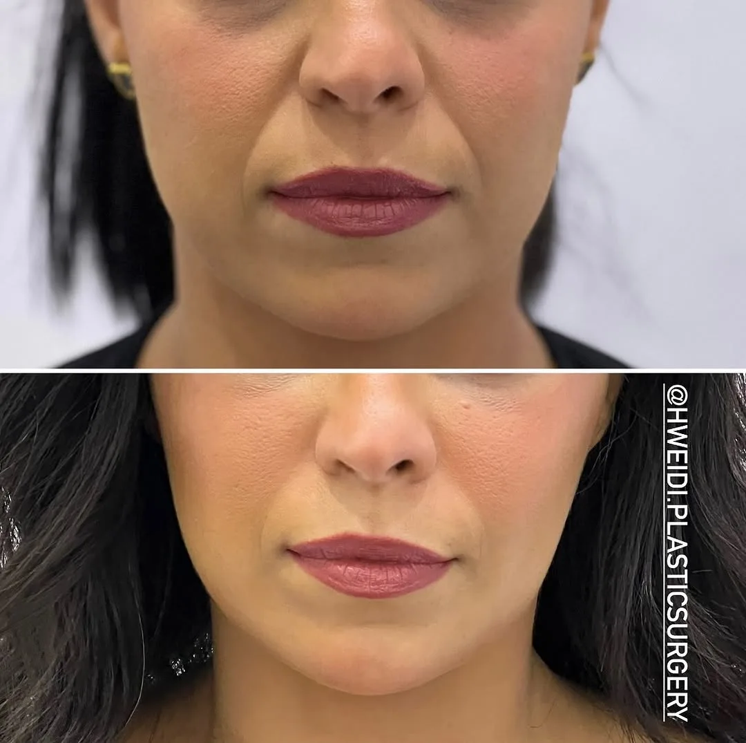 Before and after deep plane facelift — 45-year-old woman, frontal view, 6mo post-op by Dr. Laith Hweidi