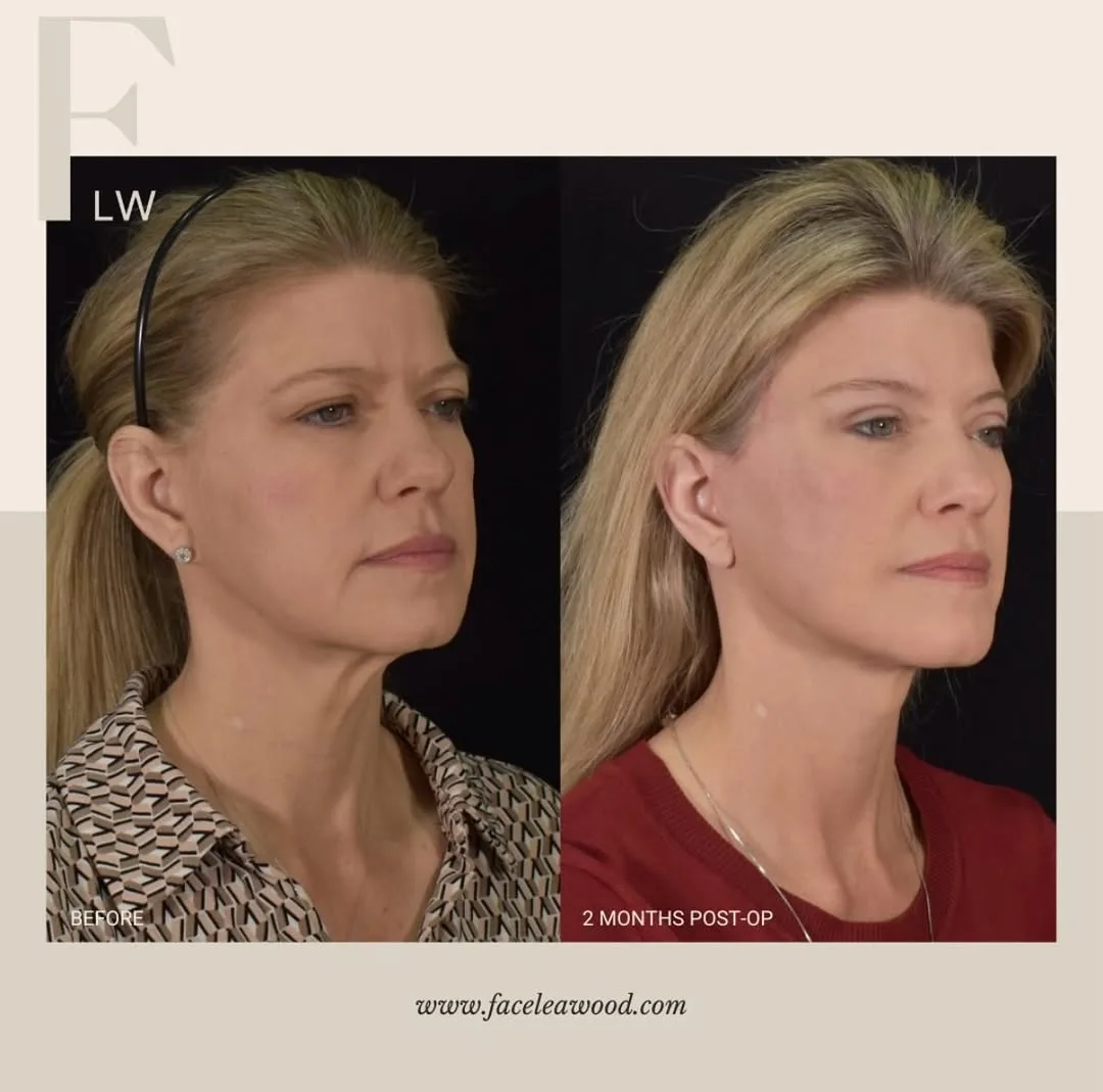 Before and after — Dr. Lauren Umstattd