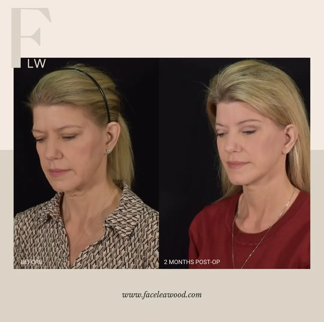 Before and after — Dr. Lauren Umstattd