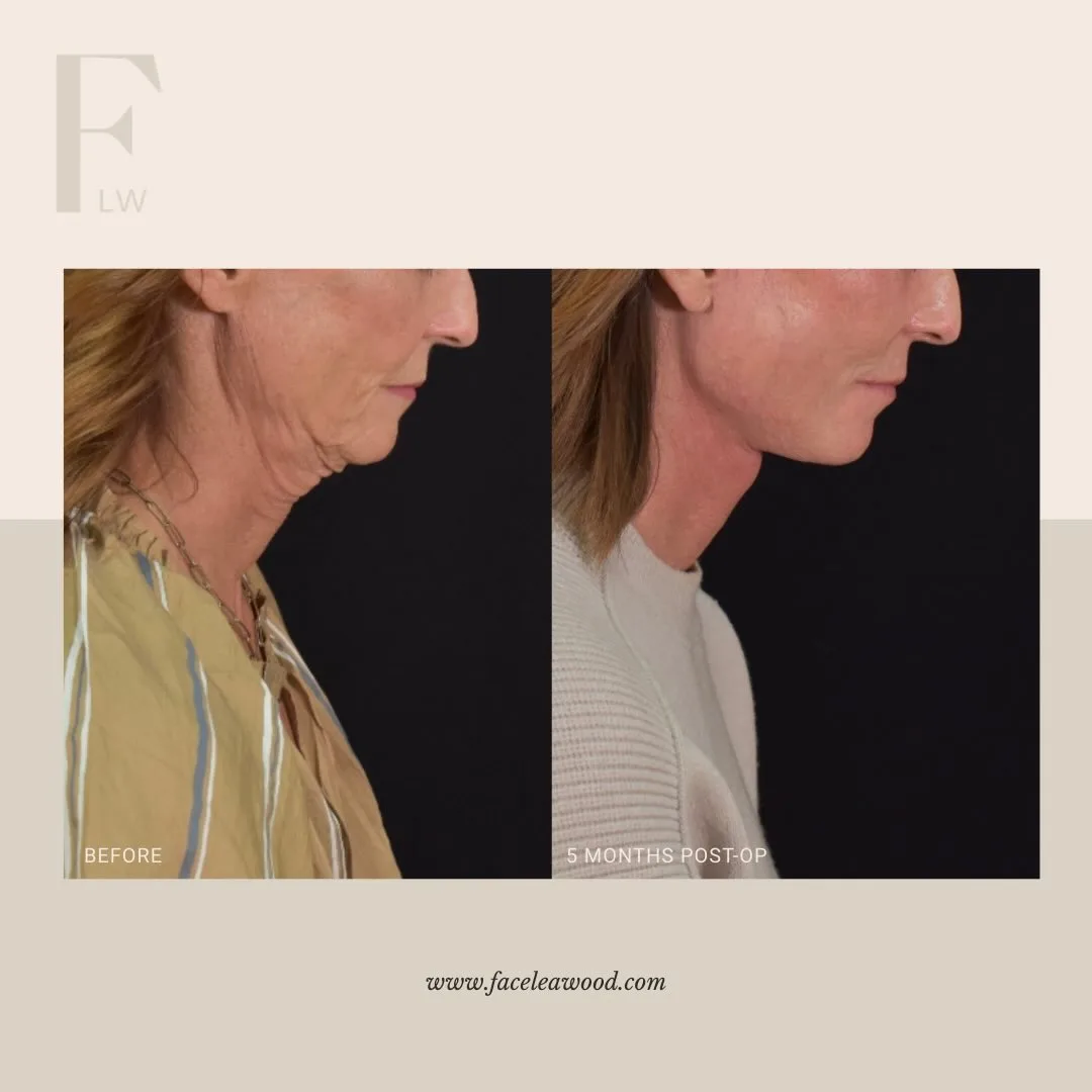 Before and after — Dr. Lauren Umstattd
