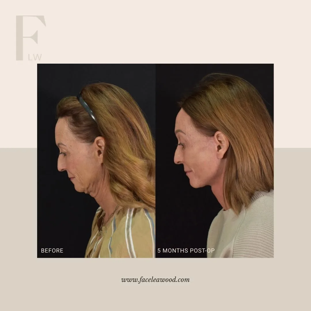 Before and after — Dr. Lauren Umstattd