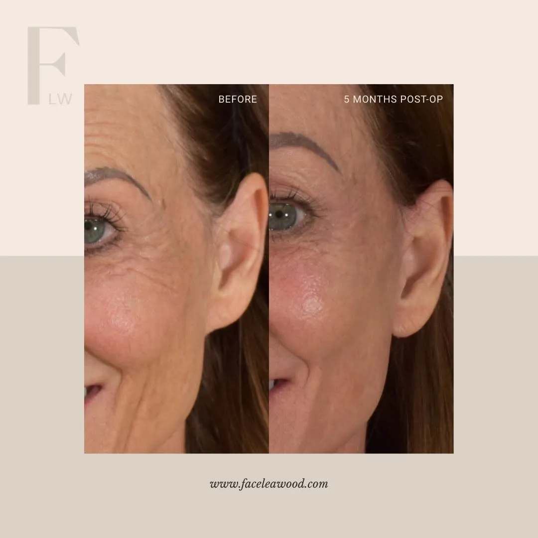 Before and after — Dr. Lauren Umstattd