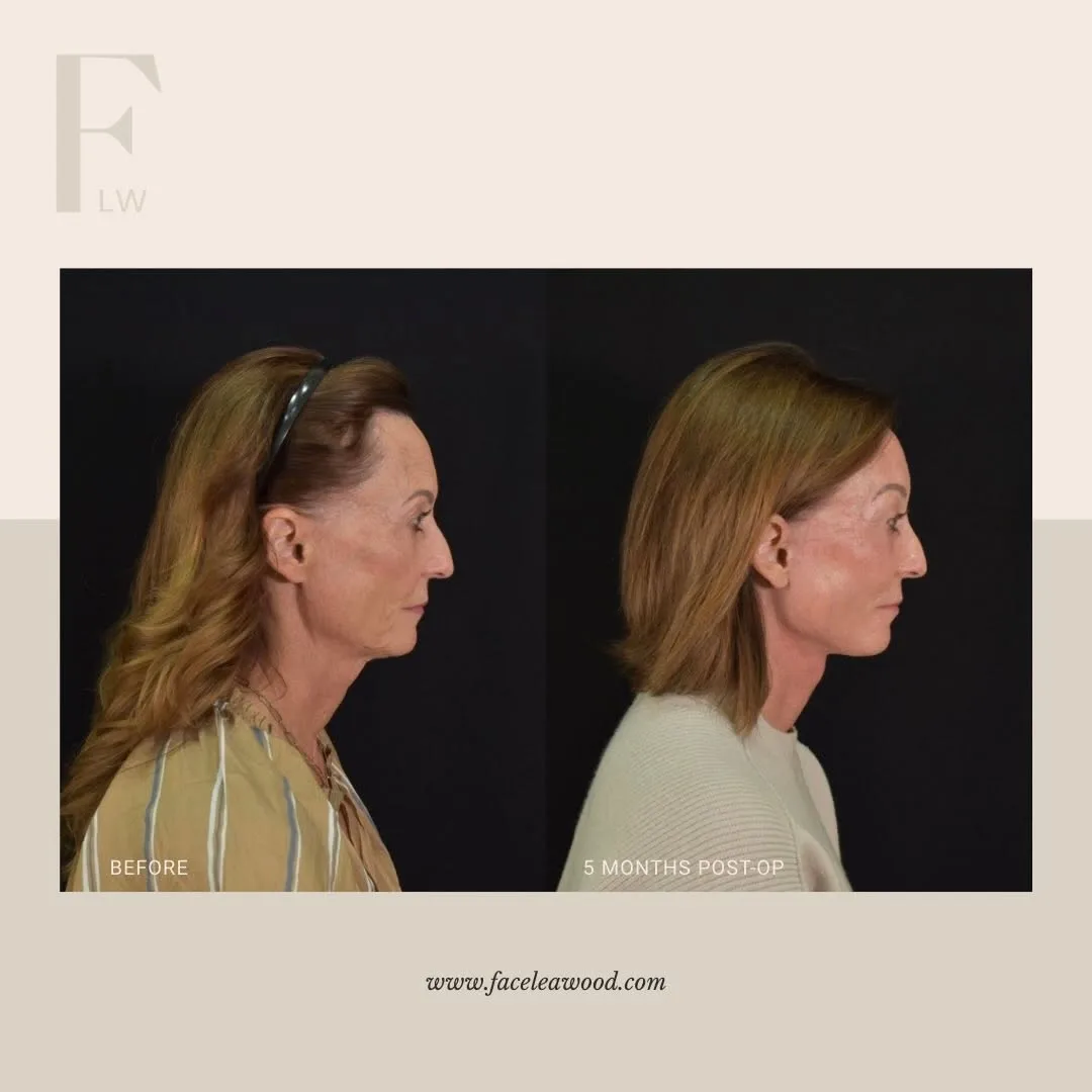 Before and after — Dr. Lauren Umstattd