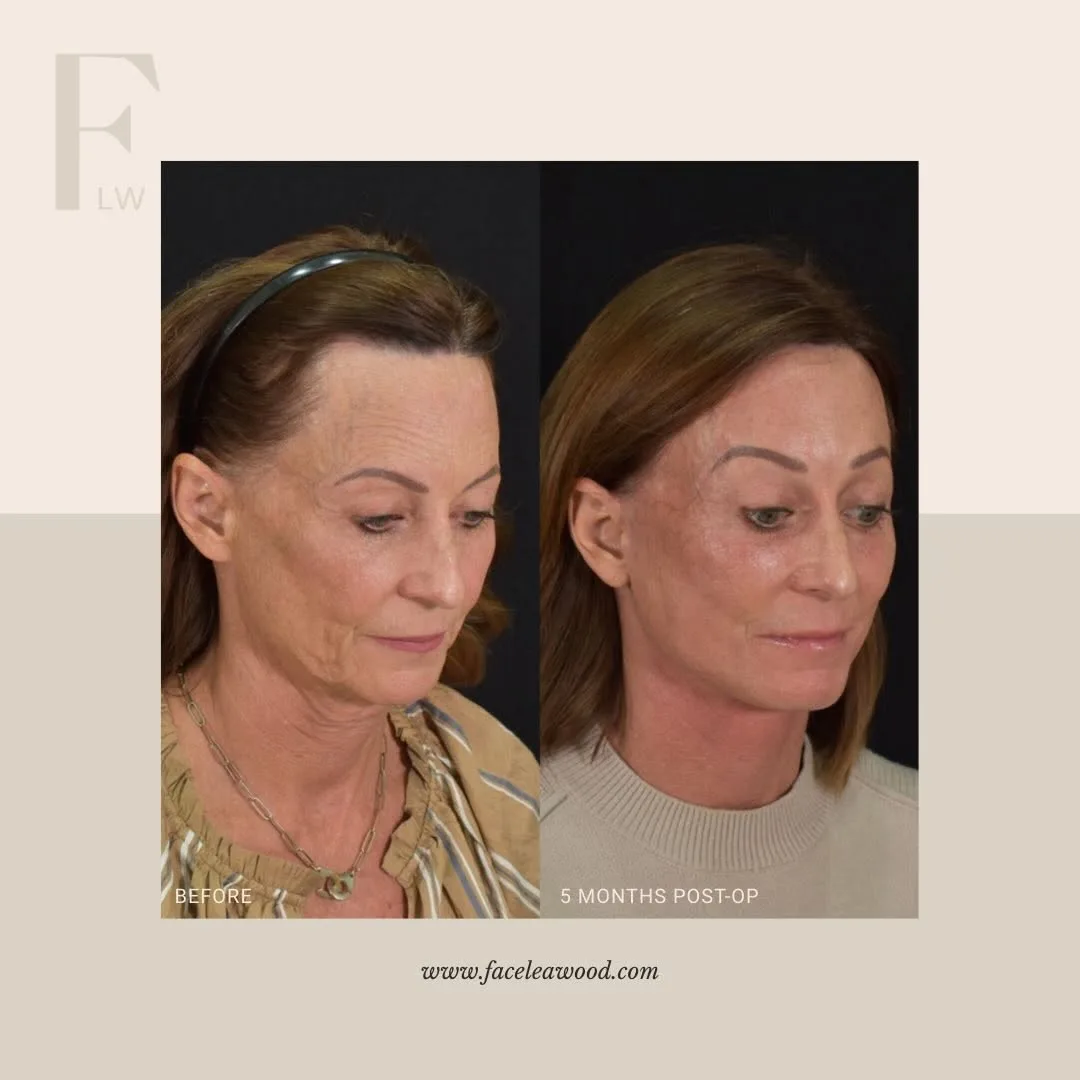 Before and after — Dr. Lauren Umstattd