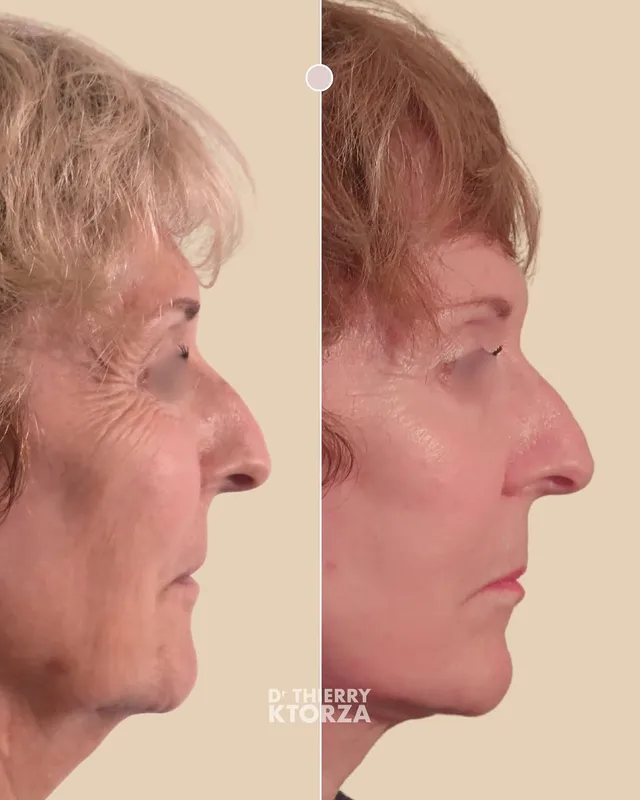 Before and after — Dr. Laurent Ktorza