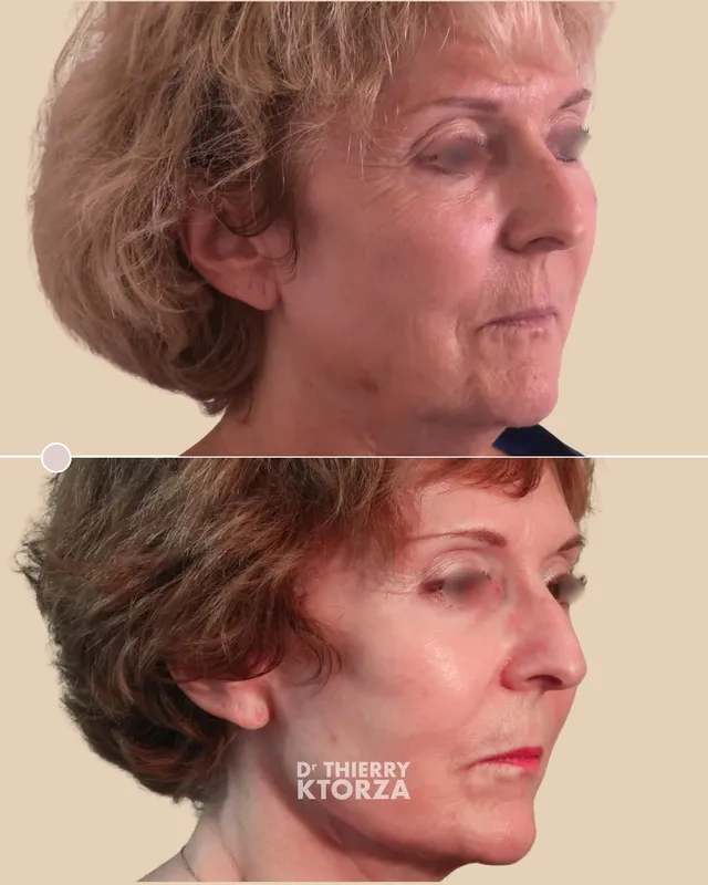 Before and after — Dr. Laurent Ktorza