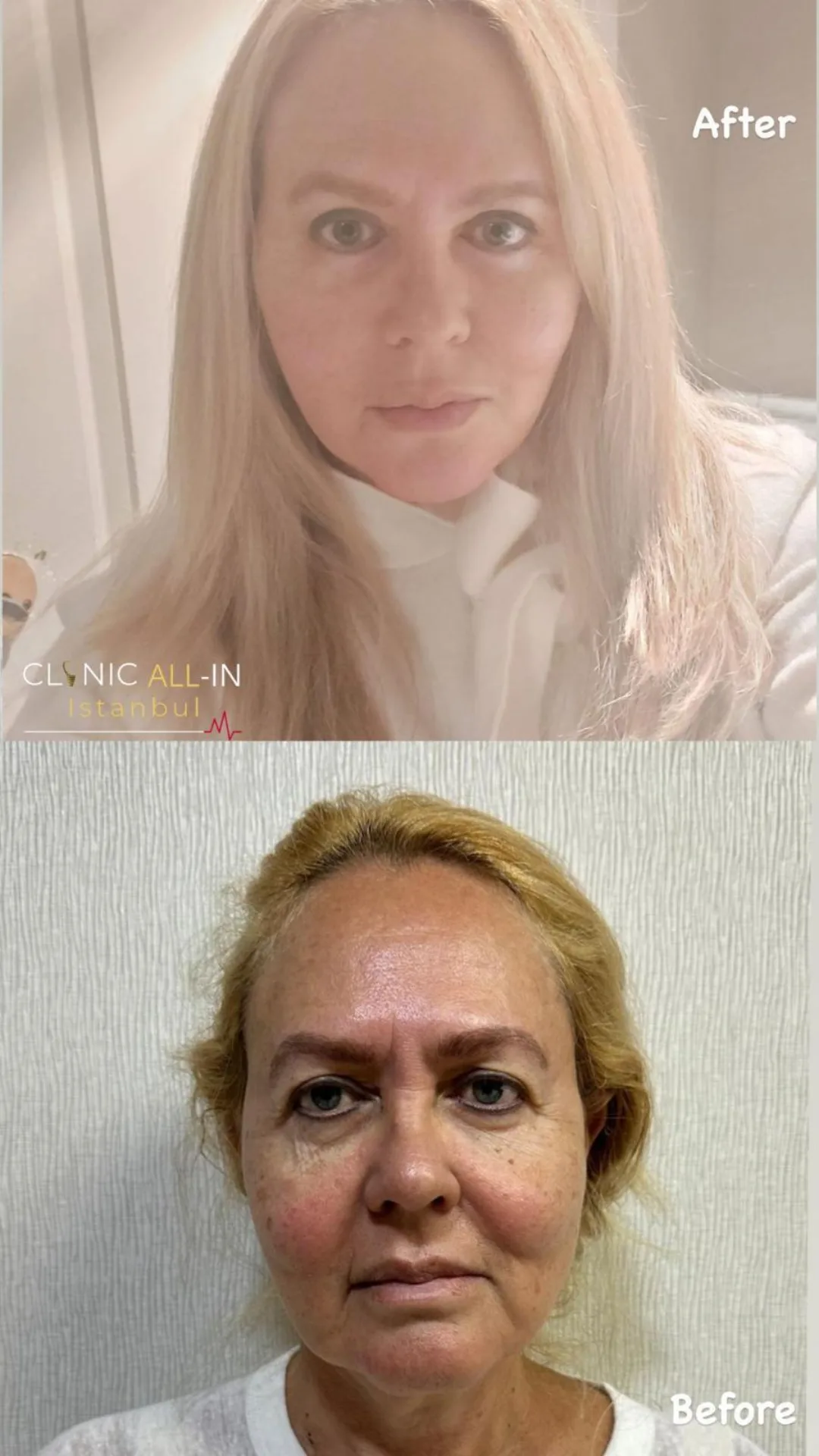 Before & After - Deep Plane Facelift by Dr. Lee Hyun-Jik