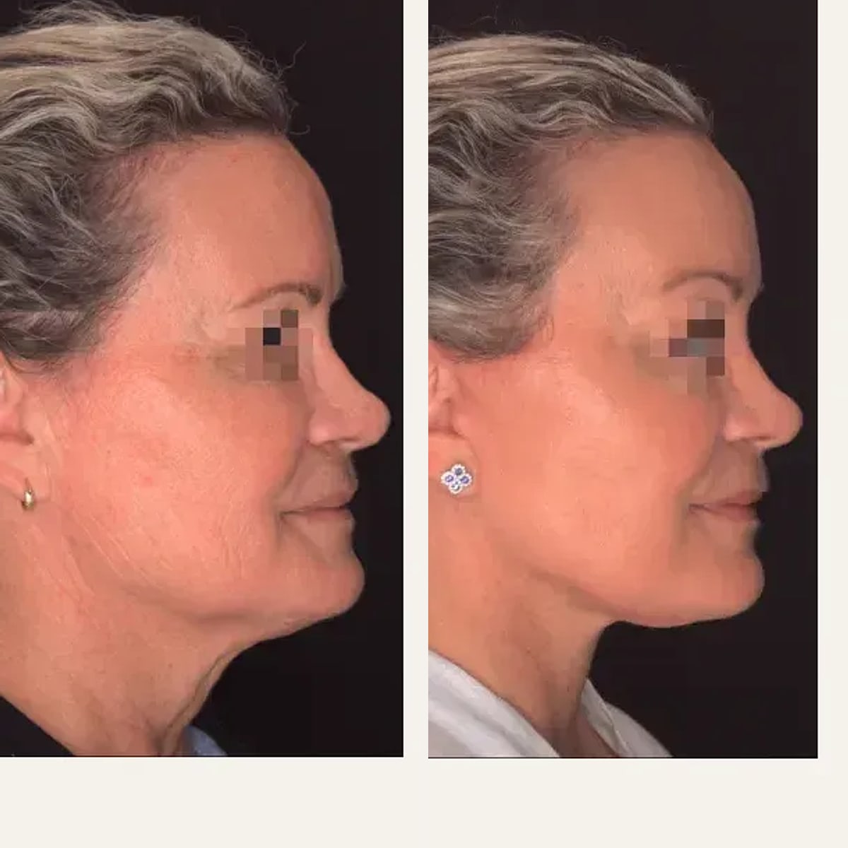 Before & After - Deep Plane Facelift by Dr. Leif Rogers