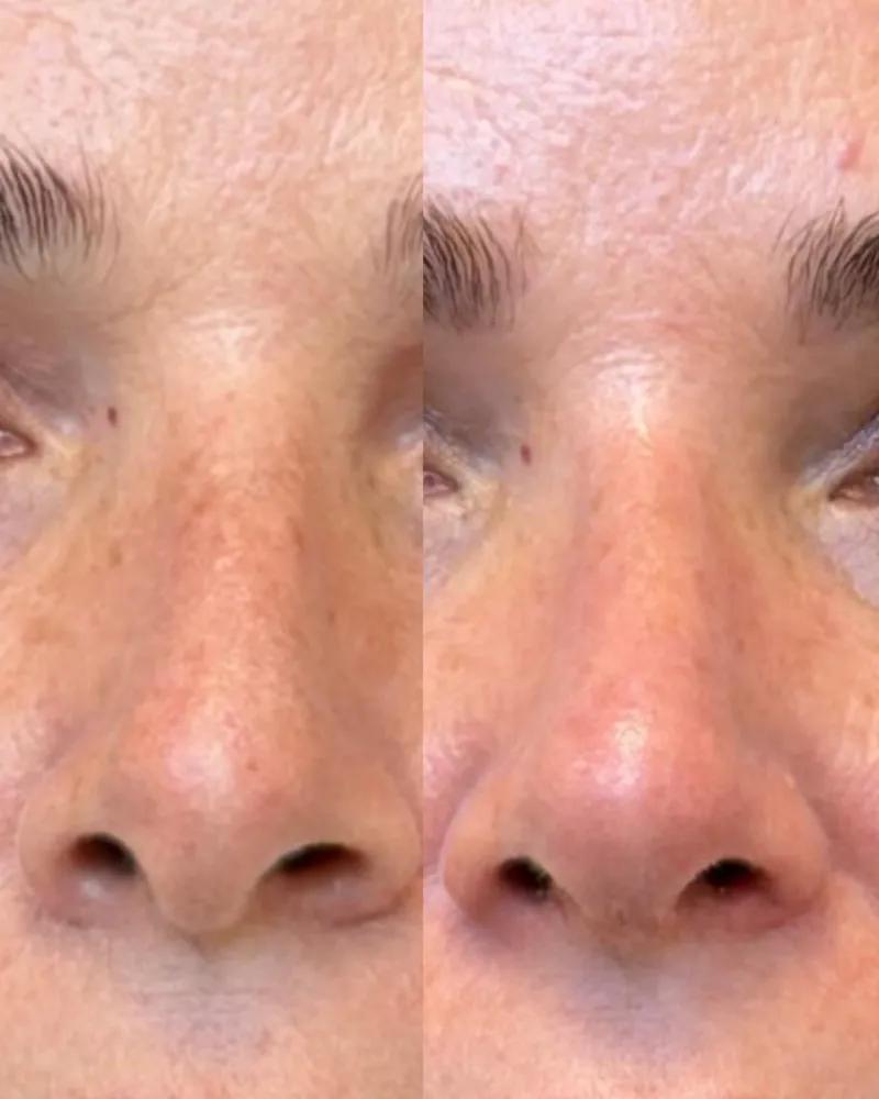 Before and after — Dr. Leonardo Bomediano