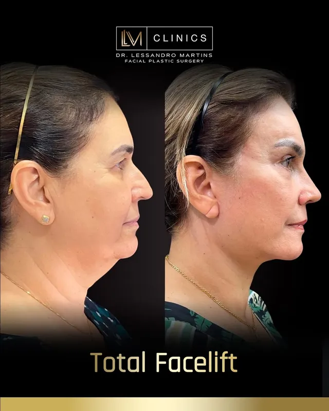 Before and after deep plane facelift, frontal view by Dr. Lessandro Martins