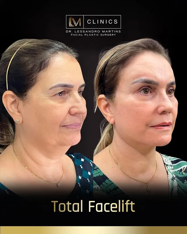 Before and after deep plane facelift, frontal view by Dr. Lessandro Martins