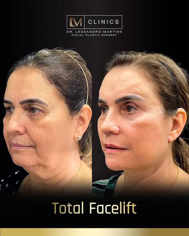 Before and after deep plane facelift, frontal view by Dr. Lessandro Martins