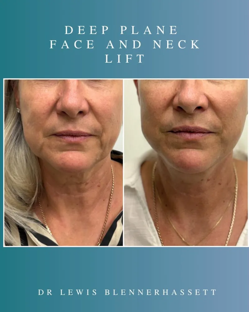 Before and after: Dr. Lewis Blennerhassett