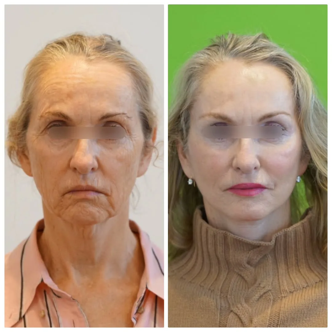 Before and after deep plane facelift — 58-year-old woman, frontal view, 7mo post-op by Dr. Linda Monshizadeh
