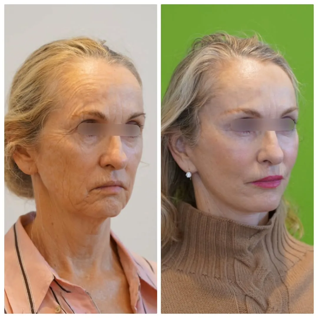 Before and after deep plane facelift — 58-year-old woman, oblique left view, 9mo post-op by Dr. Linda Monshizadeh