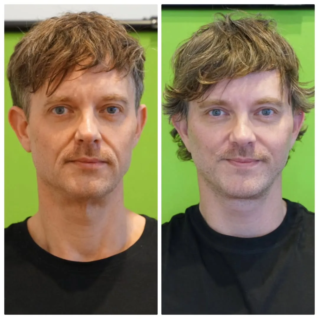 Before and after deep plane facelift — 42-year-old man, frontal view, 6mo post-op by Dr. Linda Monshizadeh