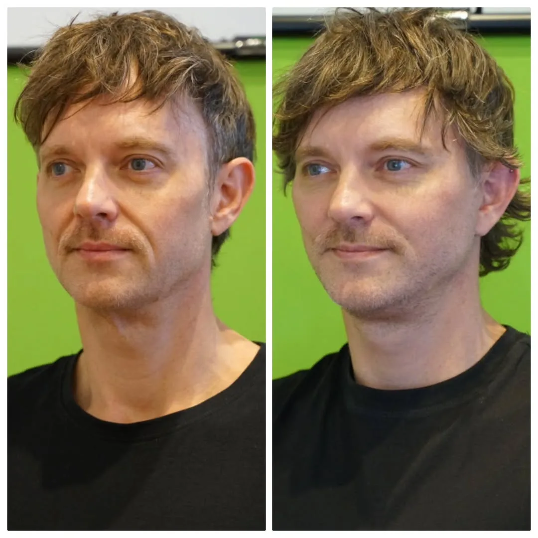 Before and after deep plane facelift — 42-year-old man, oblique right view, 6mo post-op by Dr. Linda Monshizadeh