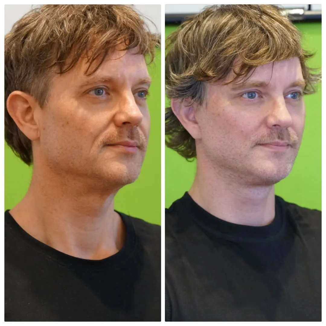 Before and after deep plane facelift — 45-year-old man, oblique right view, 6mo post-op by Dr. Linda Monshizadeh