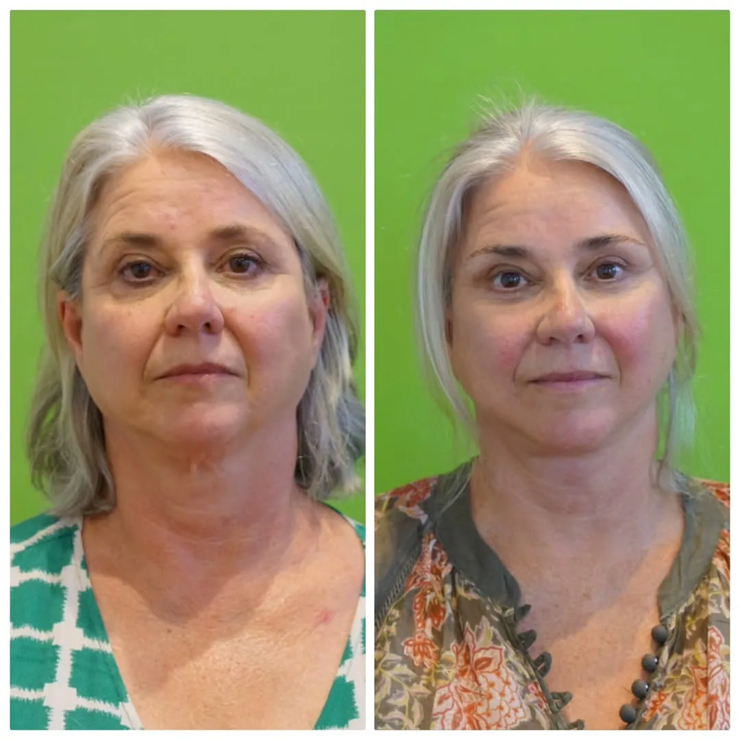 Before and after deep plane facelift — 58-year-old woman, frontal view, 8mo post-op by Dr. Linda Monshizadeh