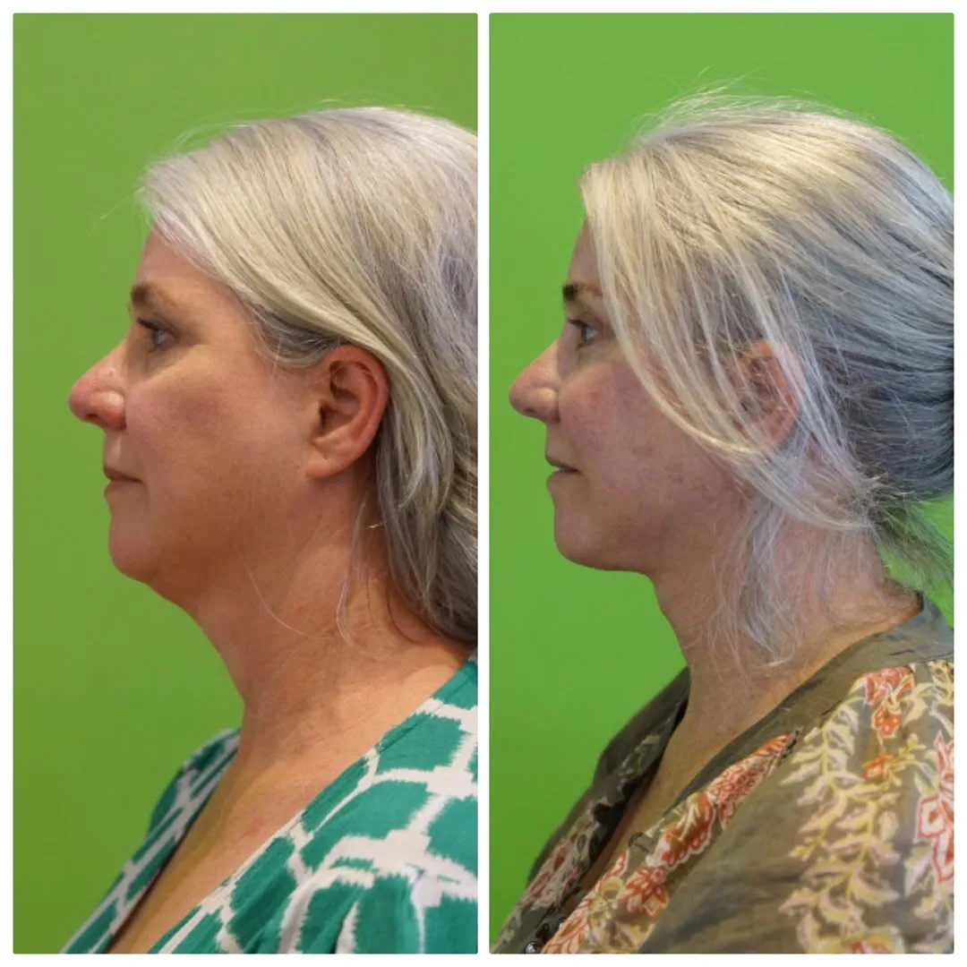Before and after deep plane facelift — 58-year-old woman, left profile view, 6mo post-op by Dr. Linda Monshizadeh