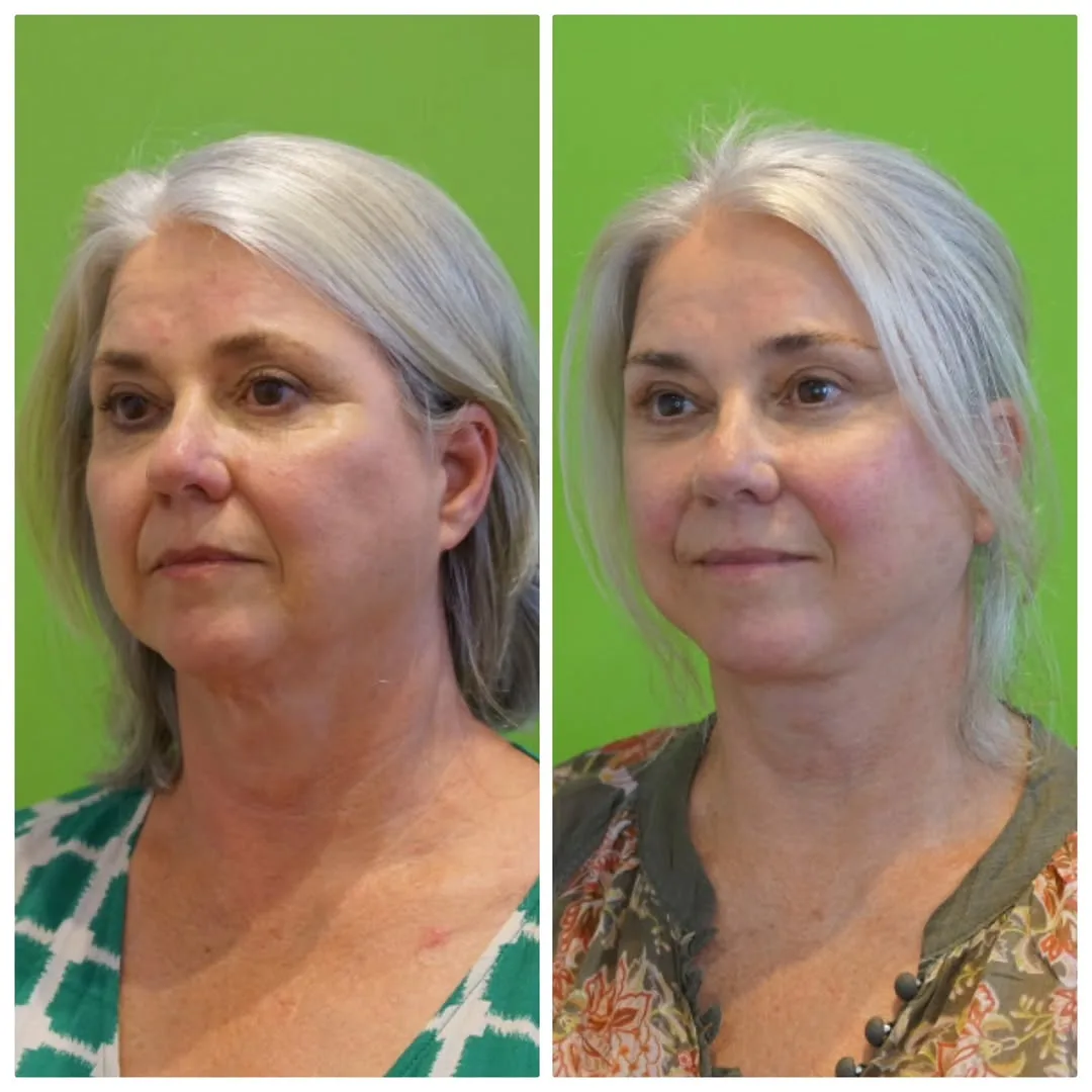 Before and after deep plane facelift — 55-year-old woman, oblique left view, 6mo post-op by Dr. Linda Monshizadeh