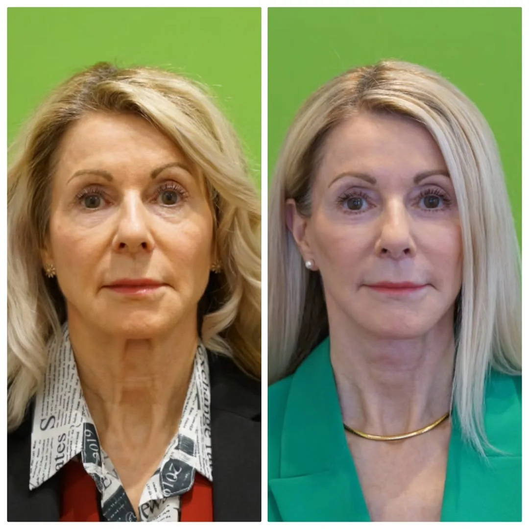 Before and after deep plane facelift — 58-year-old woman, frontal view, 8mo post-op by Dr. Linda Monshizadeh