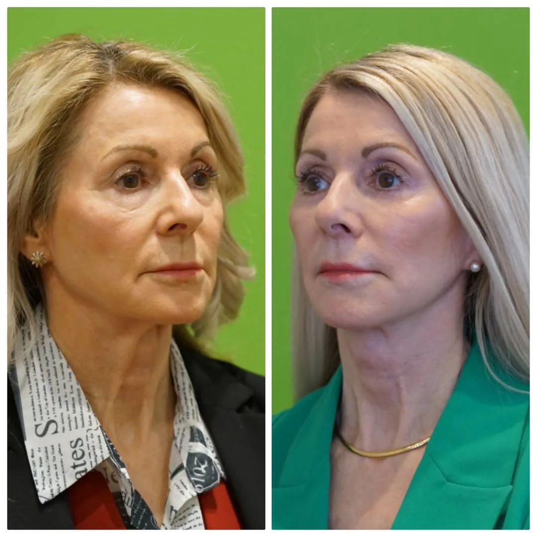 Before and after deep plane facelift — 58-year-old woman, oblique left view, 8mo post-op by Dr. Linda Monshizadeh