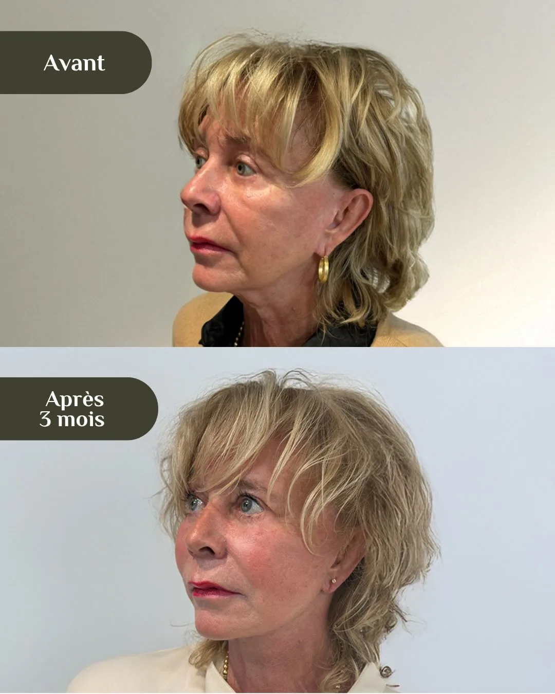 Before and after — Dr. Luca Marinelli