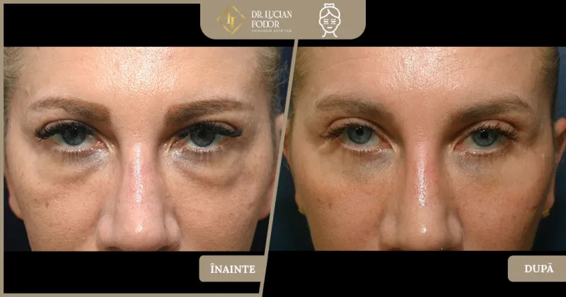 قبل وبعد - Lower Eyelid Surgery بواسطة د. Lucian Fodor