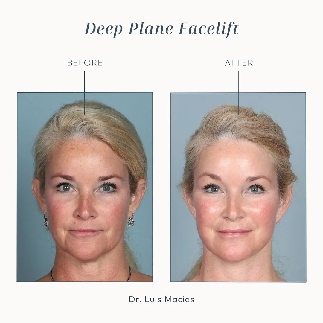 Before and after deep plane facelift — 52-year-old woman, frontal view, 6mo post-op by Dr. Luis Macias
