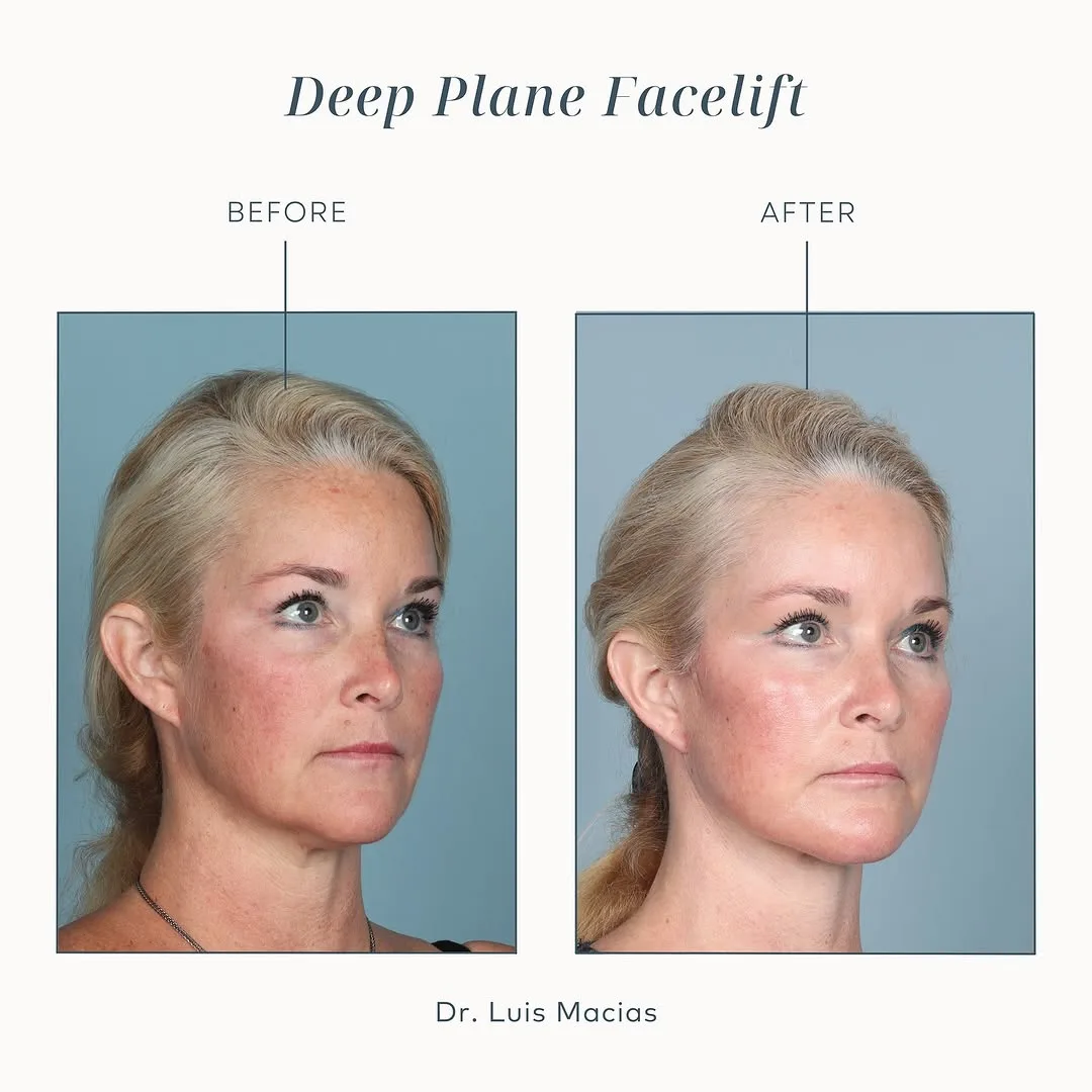 Before and after deep plane facelift — 55-year-old woman, oblique right view, 7mo post-op by Dr. Luis Macias