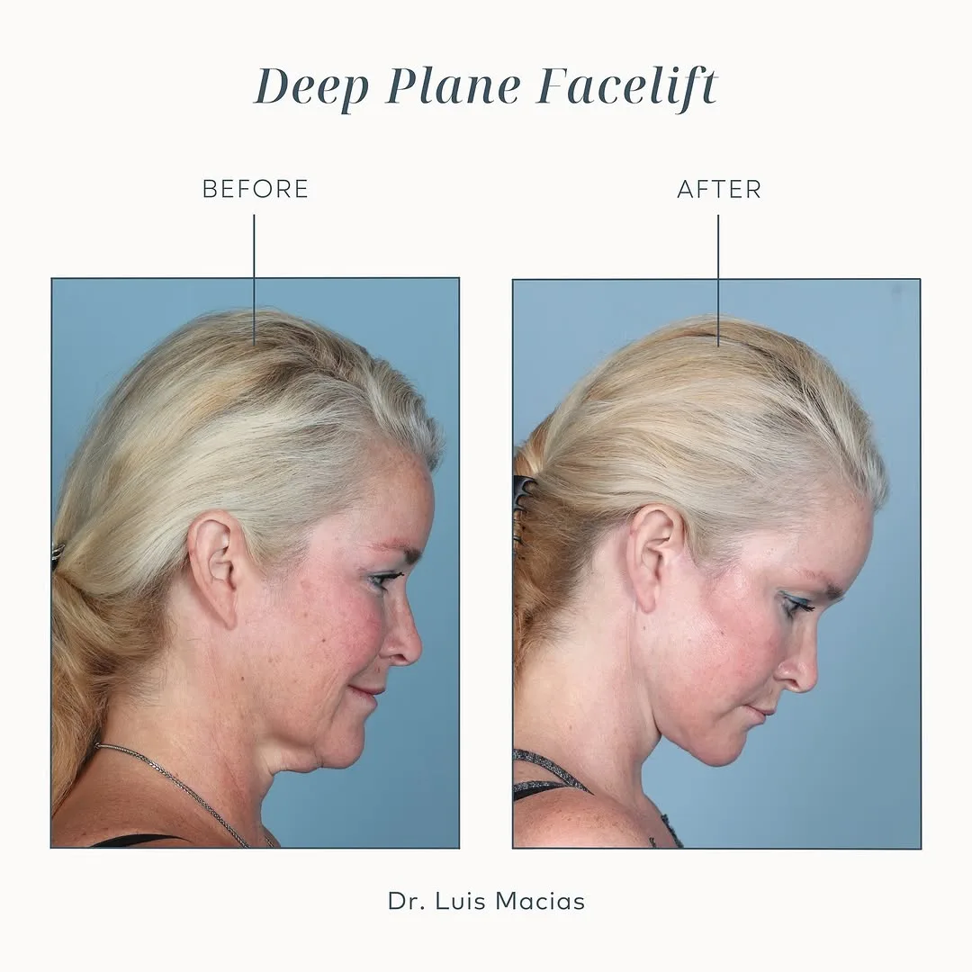 Before and after deep plane facelift — 52-year-old woman, right profile view, 6mo post-op by Dr. Luis Macias