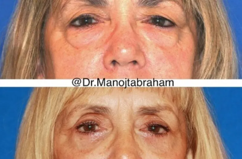 Before and after — Dr. Manoj Abraham