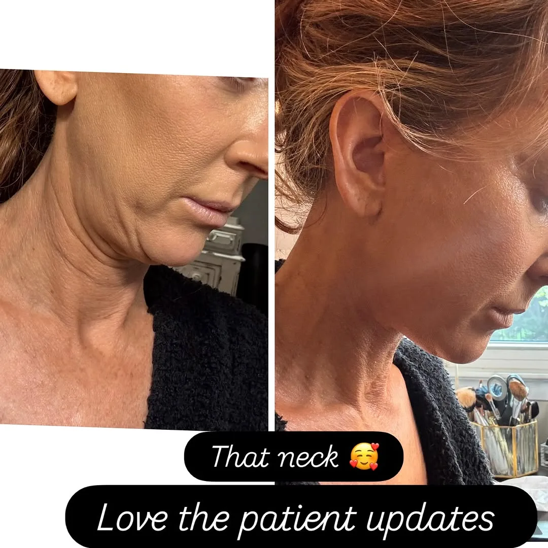 Before and after deep plane facelift — 52-year-old woman, right profile view, 3mo post-op by Dr. Mansher Singh