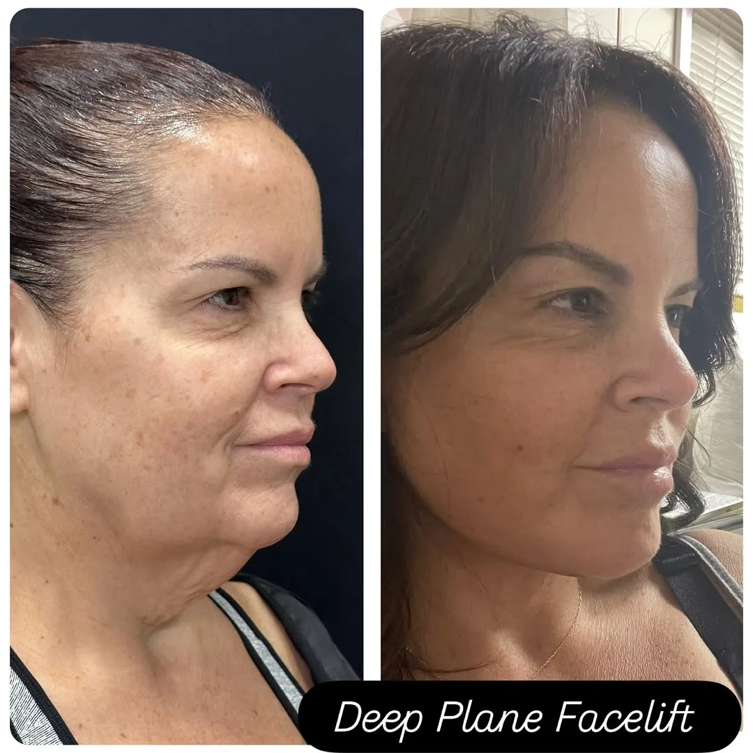Before and after deep plane facelift — 48-year-old woman, three-quarter view, 3mo post-op by Dr. Mansher Singh