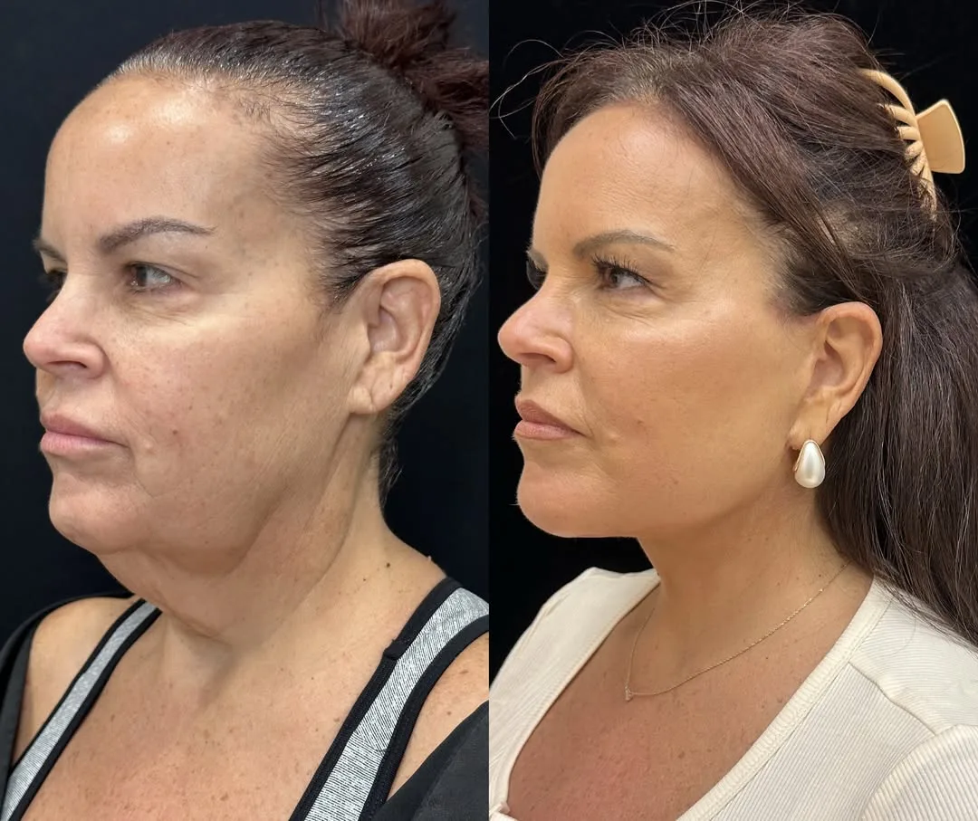 Before and after deep plane facelift — 48-year-old woman, three-quarter view, 3mo post-op by Dr. Mansher Singh