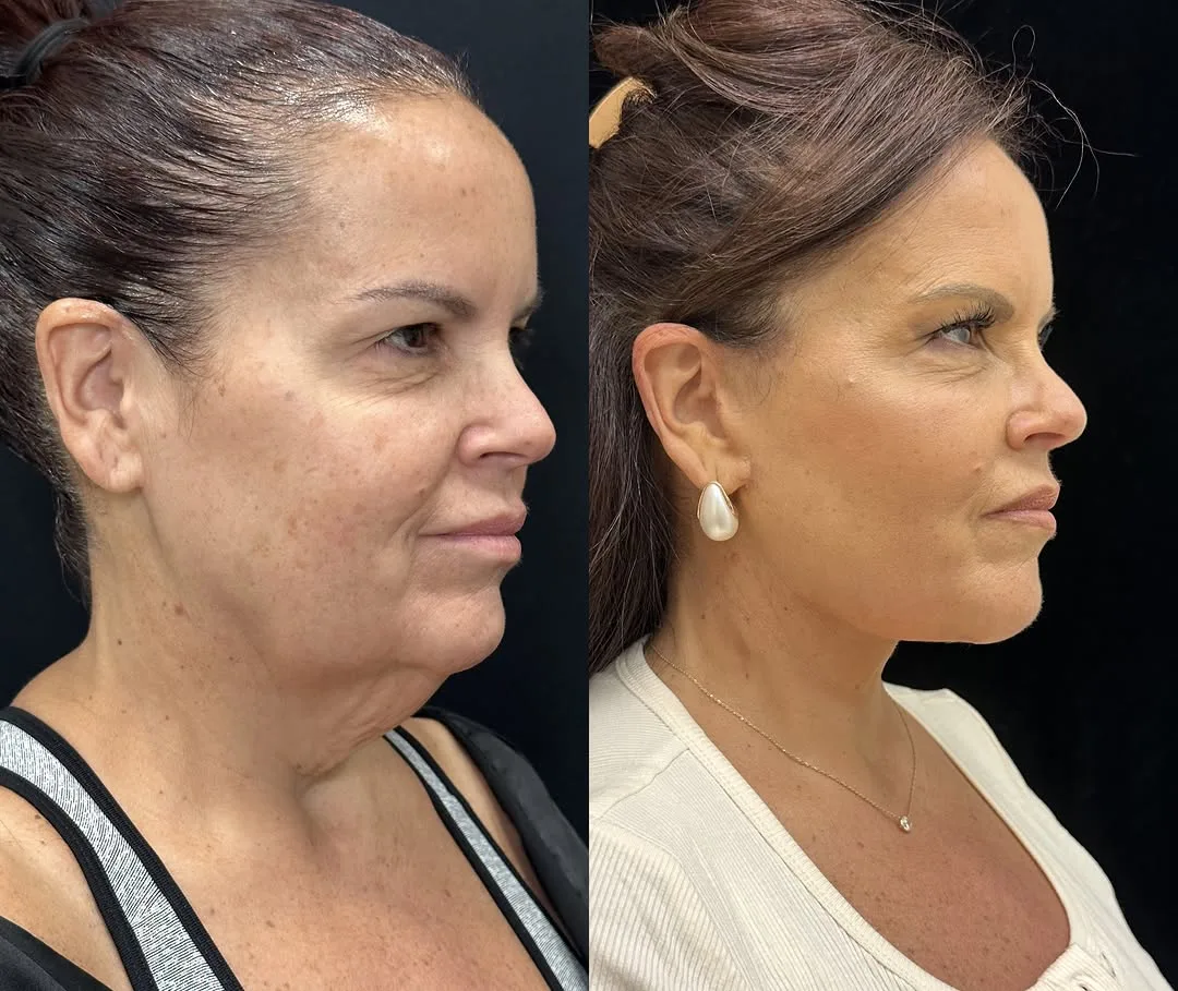 Before and after deep plane facelift — 52-year-old woman, three-quarter view, 3mo post-op by Dr. Mansher Singh