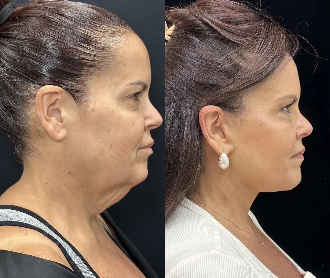 Before and after deep plane facelift — 52-year-old woman, right profile view, 3mo post-op by Dr. Mansher Singh