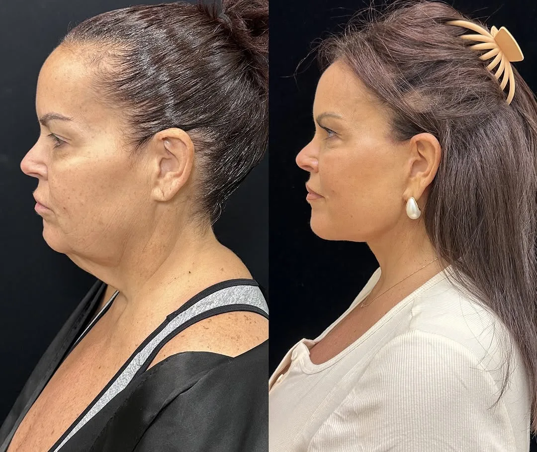 Before and after deep plane facelift — 52-year-old woman, left profile view, 3mo post-op by Dr. Mansher Singh