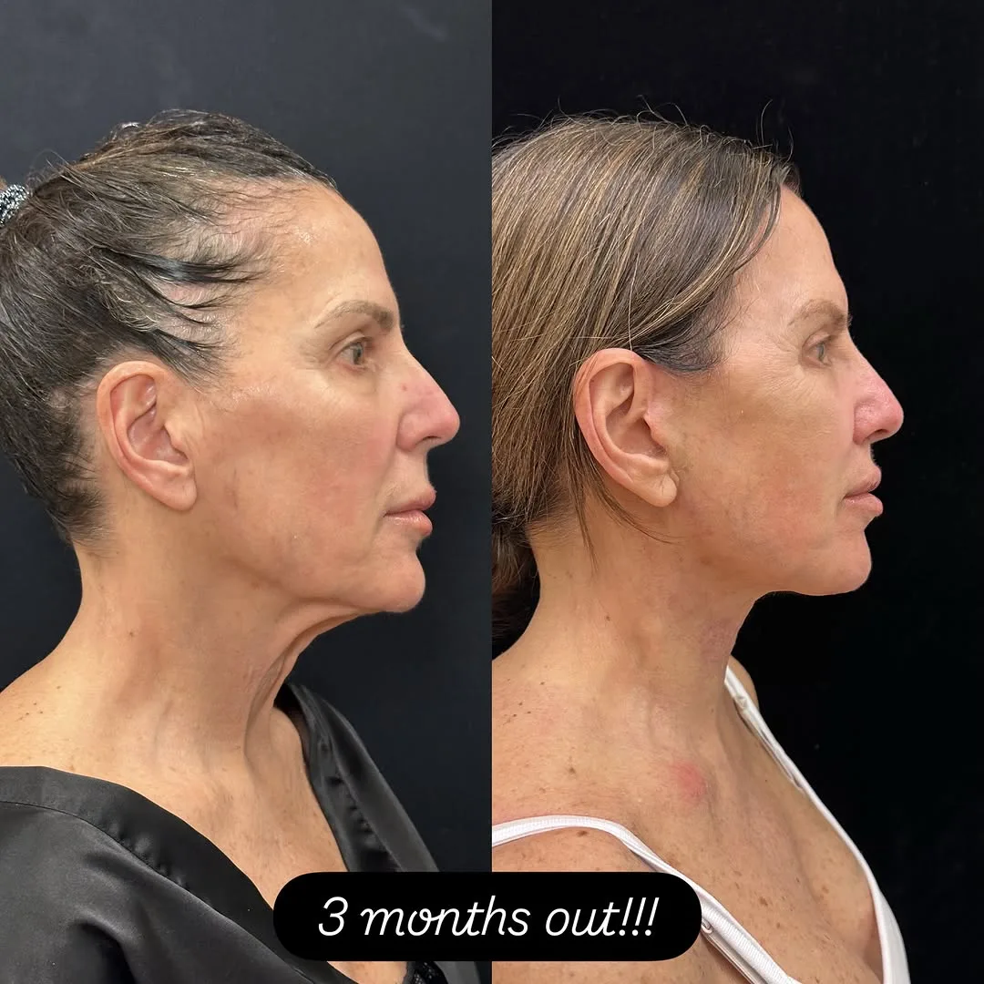 Before and after deep plane facelift — 52-year-old woman, right profile view, 3mo post-op by Dr. Mansher Singh