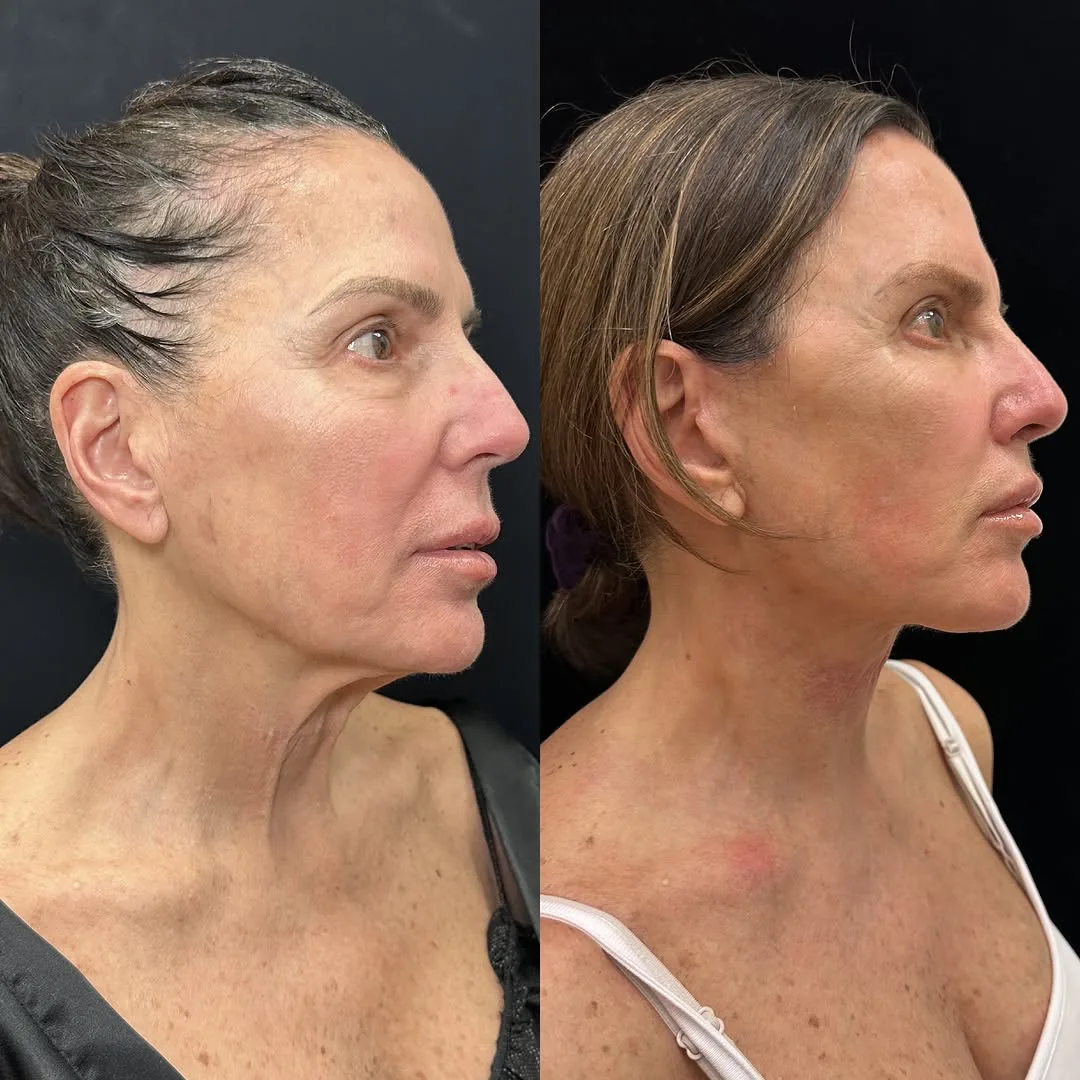Before and after deep plane facelift — 52-year-old woman, three-quarter view, 3mo post-op by Dr. Mansher Singh