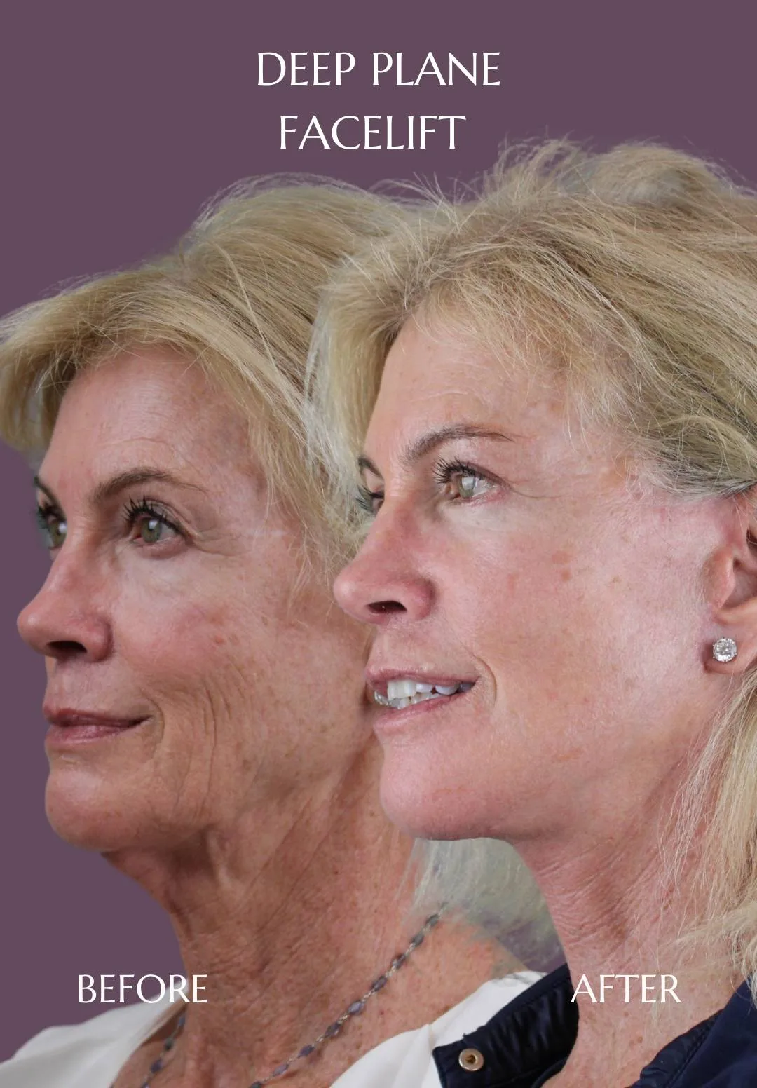 Before and after — Dr. Mara Teresa Sierra