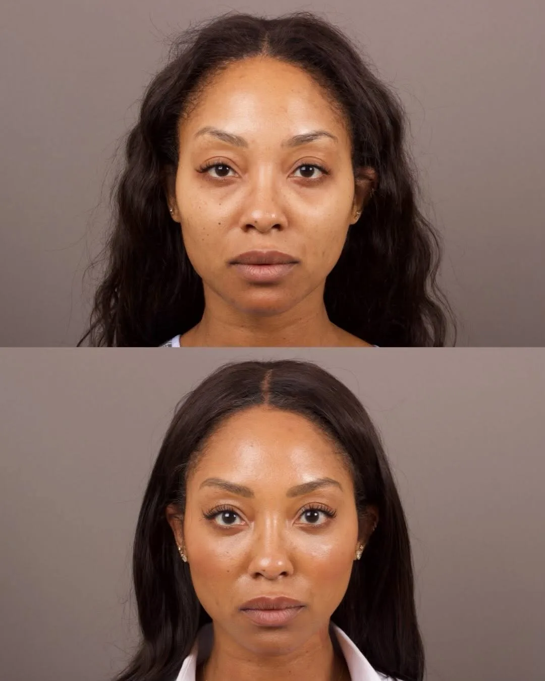 Before and after deep plane facelift — 42-year-old woman, frontal view, 7mo post-op by Dr. Marc Levin